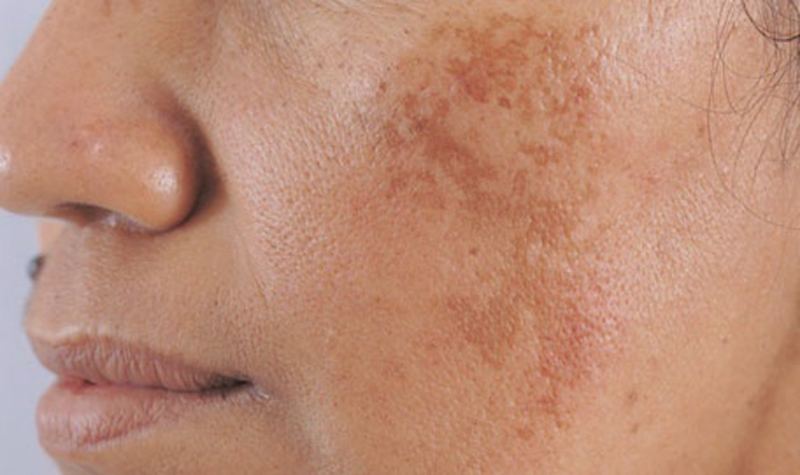 Người bị nám da có những mảng màu nâu trên mặt